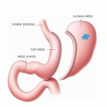 Tüp mide ameliyatı kaç saat sürer ve nasıl yapılır?